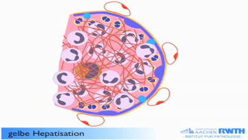 Still medium pathocast pneumonie