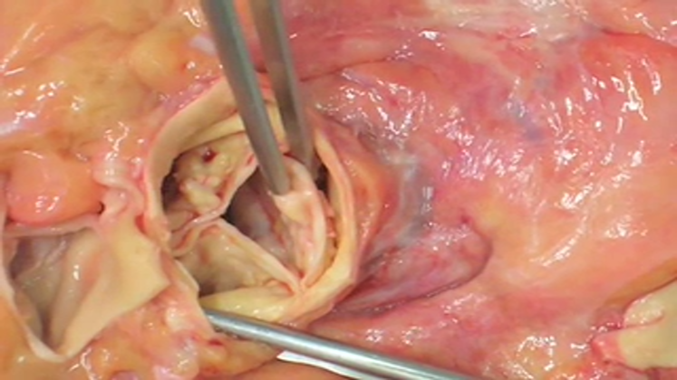 Still large pathocast  20aortenklappenstenose